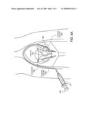 Forming Embolic Particles diagram and image