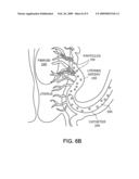 Forming Embolic Particles diagram and image