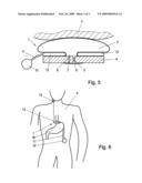 Controllable Gastric Band diagram and image