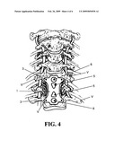 Anterior cervical staple diagram and image