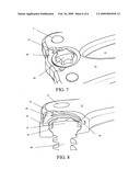 Anterior cervical staple diagram and image