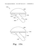 Modular Ankle Prosthesis and Associated Method diagram and image