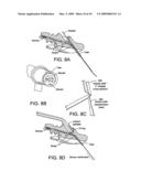 Combined sensor and infusion set using separated sites diagram and image