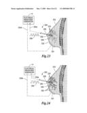 Electrical ablation surgical instruments diagram and image