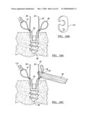 METHOD AND APPARATUS FOR COUPLING SOFT TISSUE TO BONE diagram and image