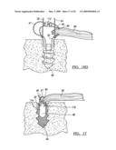 METHOD AND APPARATUS FOR COUPLING SOFT TISSUE TO BONE diagram and image