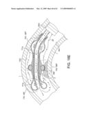 Rotational Atherectomy Device with Distal Protection Capability and Method of Use diagram and image