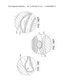 Rotational Atherectomy Device with Distal Protection Capability and Method of Use diagram and image