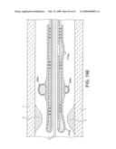 Rotational Atherectomy Device with Distal Protection Capability and Method of Use diagram and image