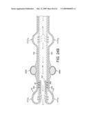 Rotational Atherectomy Device with Distal Protection Capability and Method of Use diagram and image