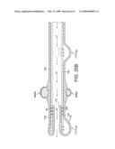 Rotational Atherectomy Device with Distal Protection Capability and Method of Use diagram and image