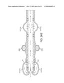 Rotational Atherectomy Device with Distal Protection Capability and Method of Use diagram and image