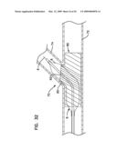 BIFURCATION POST-DILATATION BALLOON AND METHODS diagram and image