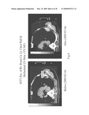 DENDRITIC CELL TUMOR INJECTION (DCTI) THERAPY diagram and image