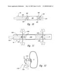 METHODS AND SYSTEMS FOR THERMALLY-INDUCED RENAL NEUROMODULATION diagram and image