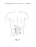 METHODS AND SYSTEMS FOR THERMALLY-INDUCED RENAL NEUROMODULATION diagram and image