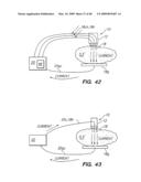 Tissue surface treatment apparatus and method diagram and image