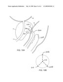 Prostate cancer ablation diagram and image