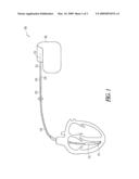 MEDICAL DEVICE HAVING A GLASS COATING AND METHOD THEREFOR diagram and image