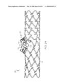 Stent with Protruding Branch Portion for Bifurcated Vessels diagram and image