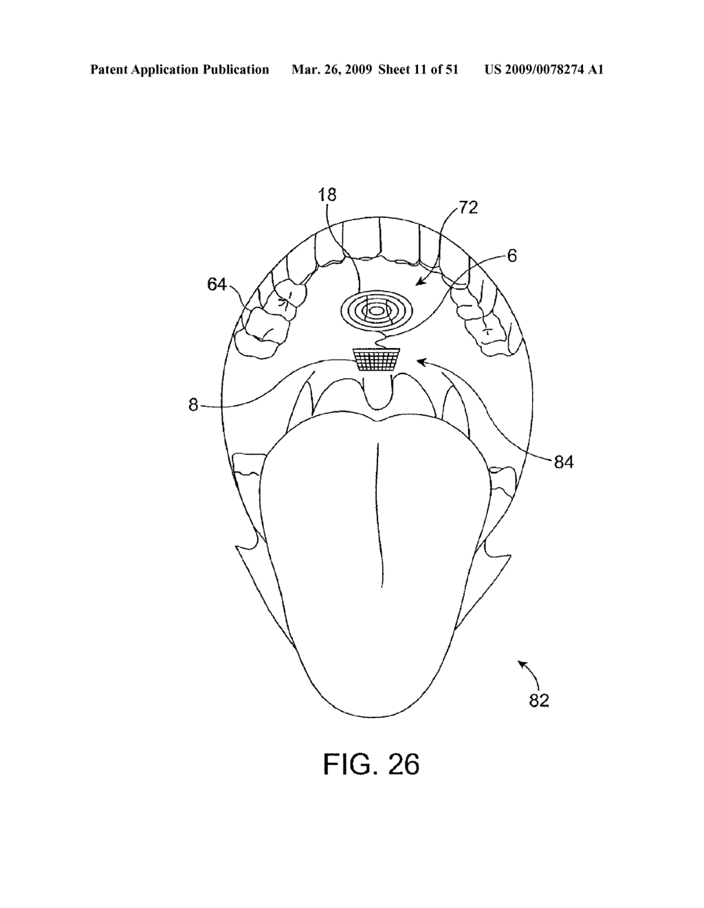 Implantable Obstructive Sleep Apnea Sensor - diagram, schematic, and image 12