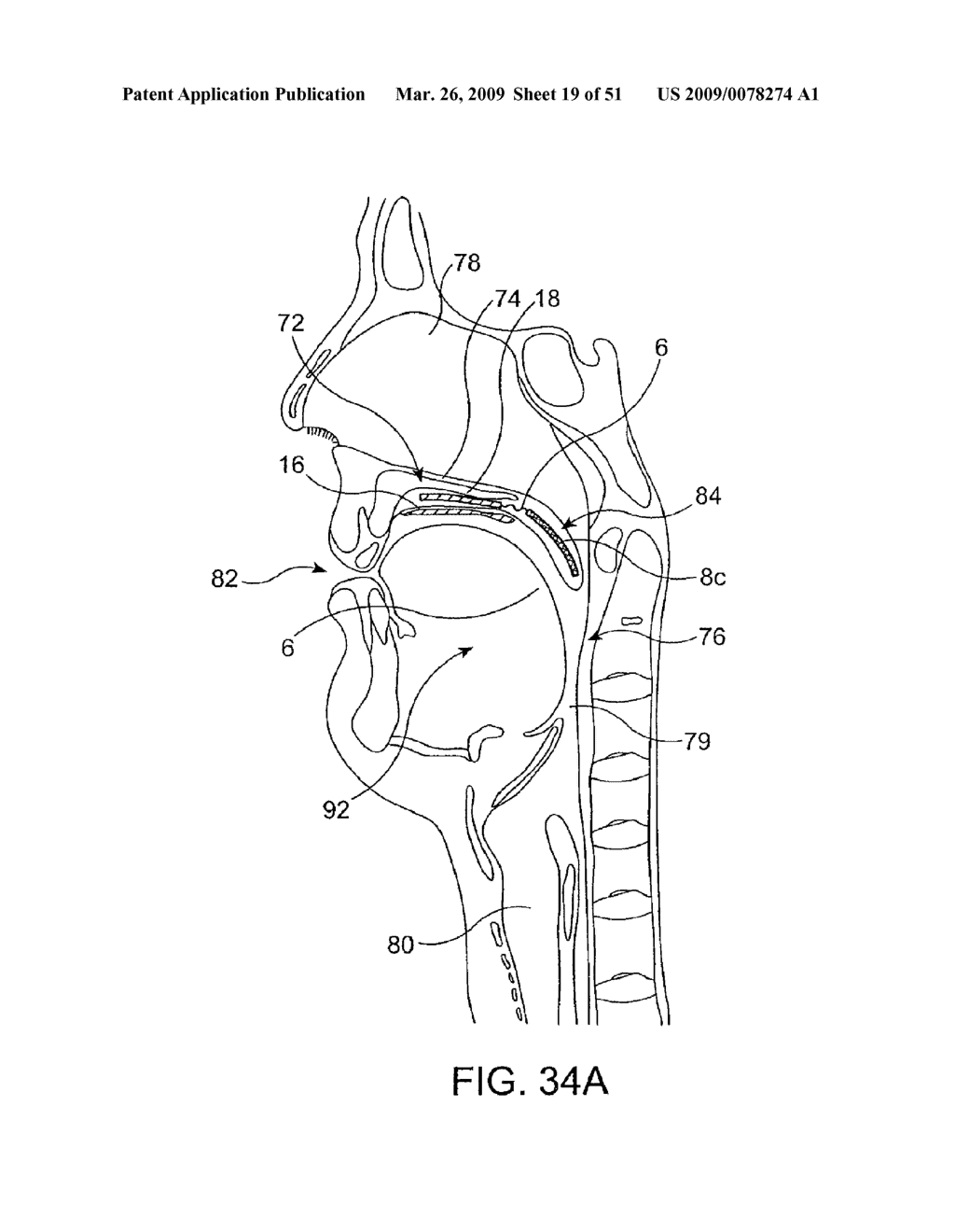 Implantable Obstructive Sleep Apnea Sensor - diagram, schematic, and image 20