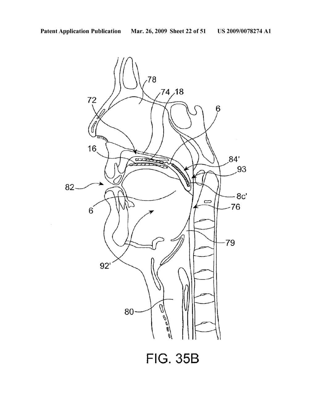 Implantable Obstructive Sleep Apnea Sensor - diagram, schematic, and image 23