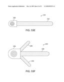 Implantable Obstructive Sleep Apnea Sensor diagram and image