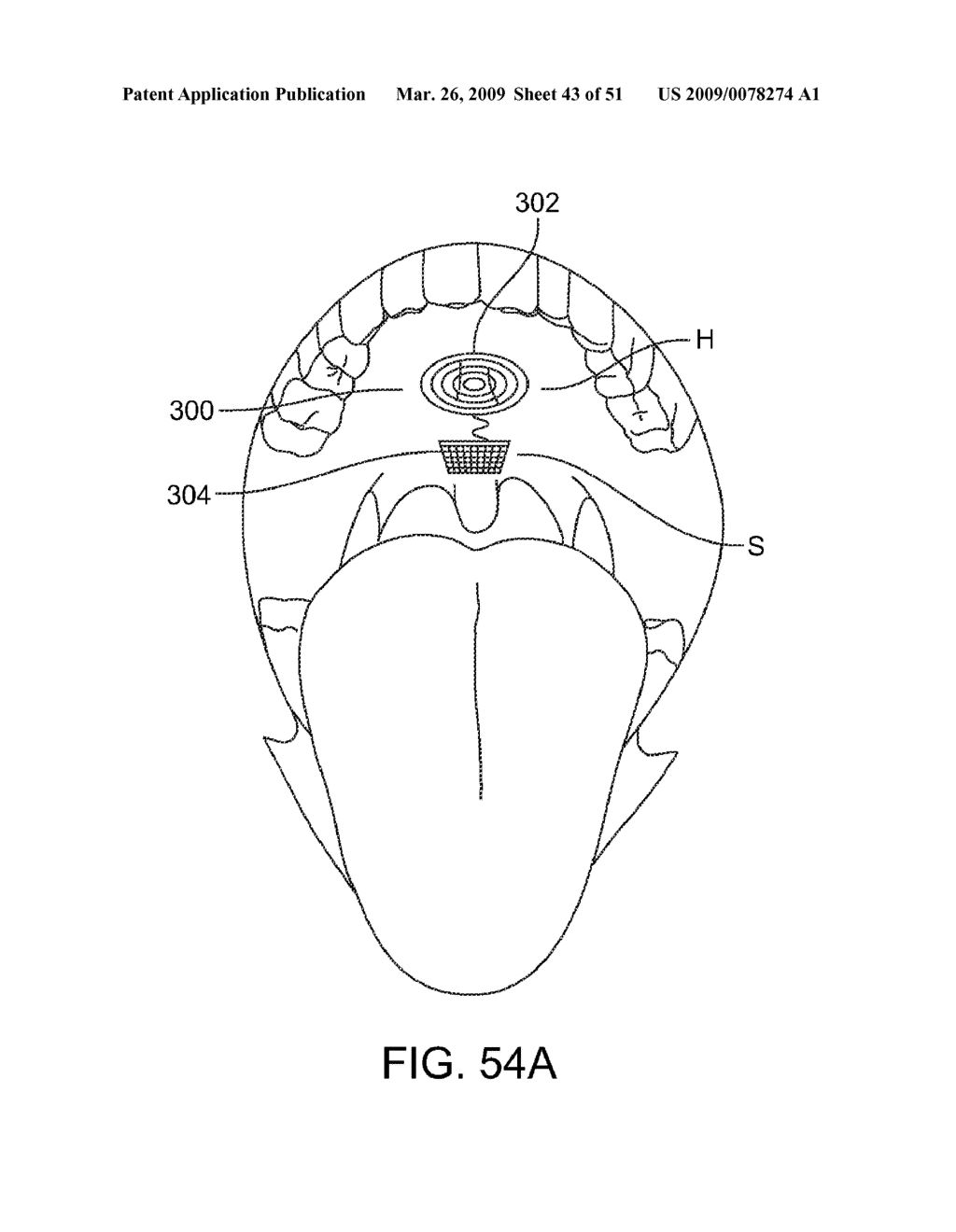 Implantable Obstructive Sleep Apnea Sensor - diagram, schematic, and image 44