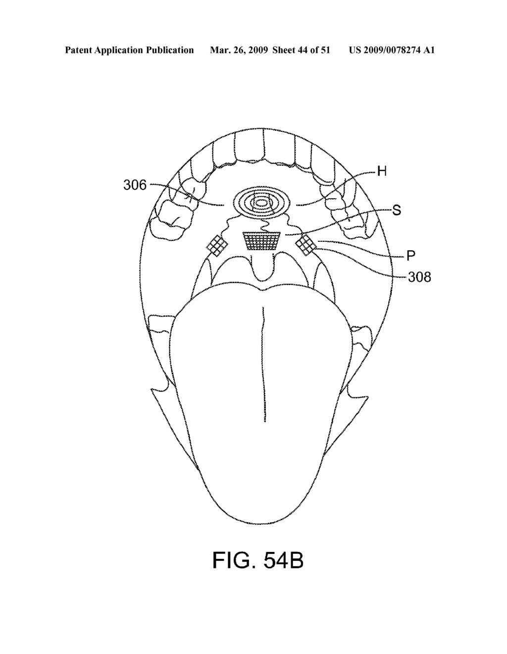 Implantable Obstructive Sleep Apnea Sensor - diagram, schematic, and image 45