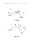 Palatal Implant Fixation Devices and Methods diagram and image