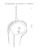 METHOD AND APPARATUS FOR WIREPLASTY BONE RESECTION diagram and image