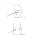 Transpedicular, Extrapedicular and Transcorporeal Approaches to the Intervertebral Discs diagram and image