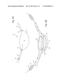 Transpedicular, Extrapedicular and Transcorporeal Approaches to the Intervertebral Discs diagram and image