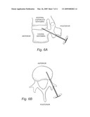 Transpedicular, Extrapedicular and Transcorporeal Approaches to the Intervertebral Discs diagram and image