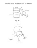 Transpedicular, Extrapedicular and Transcorporeal Approaches to the Intervertebral Discs diagram and image