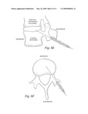 Transpedicular, Extrapedicular and Transcorporeal Approaches to the Intervertebral Discs diagram and image