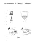 INTERVERTEBRAL DISC PROSTHESIS FOR UNIVERSAL APPLICATION diagram and image