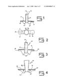 EAR TUBES diagram and image