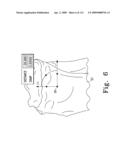 Customized Patient-Specific Multi-Cutting Blocks diagram and image