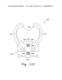 Customized Patient-Specific Multi-Cutting Blocks diagram and image