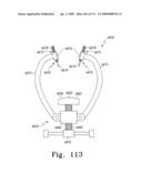 Customized Patient-Specific Multi-Cutting Blocks diagram and image