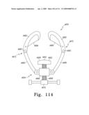 Customized Patient-Specific Multi-Cutting Blocks diagram and image