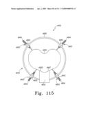 Customized Patient-Specific Multi-Cutting Blocks diagram and image