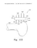 Customized Patient-Specific Multi-Cutting Blocks diagram and image