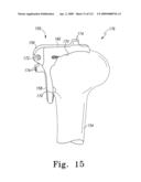 Customized Patient-Specific Multi-Cutting Blocks diagram and image