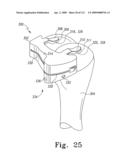 Customized Patient-Specific Multi-Cutting Blocks diagram and image