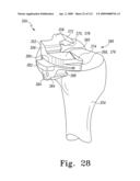 Customized Patient-Specific Multi-Cutting Blocks diagram and image