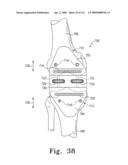 Customized Patient-Specific Multi-Cutting Blocks diagram and image