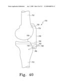 Customized Patient-Specific Multi-Cutting Blocks diagram and image